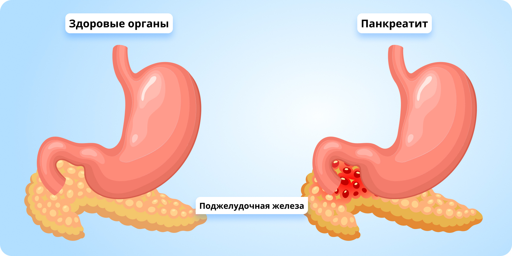 Co je užitečné pro pankreatitidu a cholecystitidu